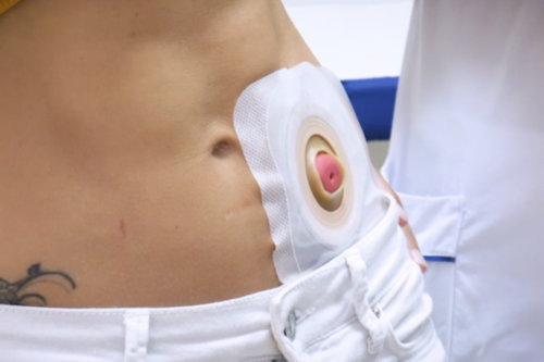 Unidad de ostomía. Apoyo técnico y emocional al paciente ostomizado.