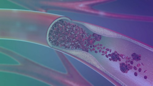 Pequeñas partículas óseas halladas en la sangre podrían arrojar luz sobre los accidentes cardiovasculares