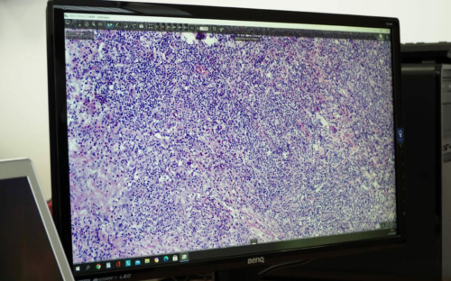 Predicción de la supervivencia en pacientes con Linfoma de Hodgkin clásico mediante herramientas de inteligencia artificial 